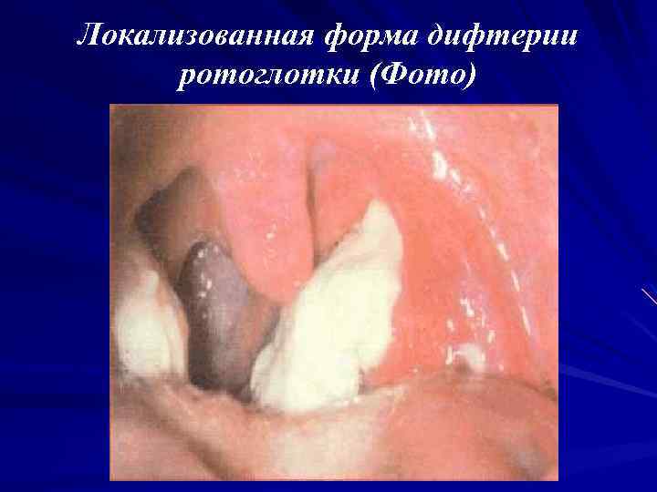 Локализованная форма дифтерии ротоглотки (Фото) 