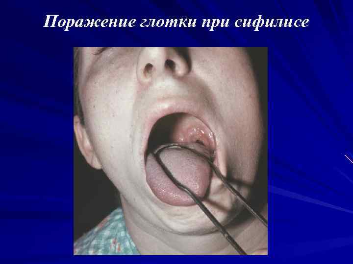 Поражение глотки при сифилисе 
