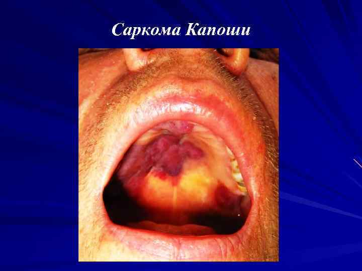 Саркома Капоши 