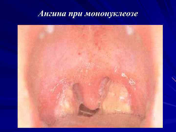 Ангина при мононуклеозе 