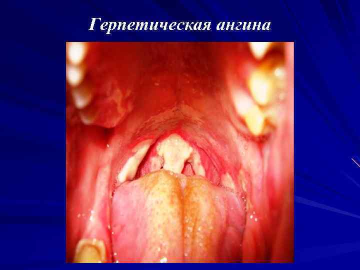 Герпетическая ангина 