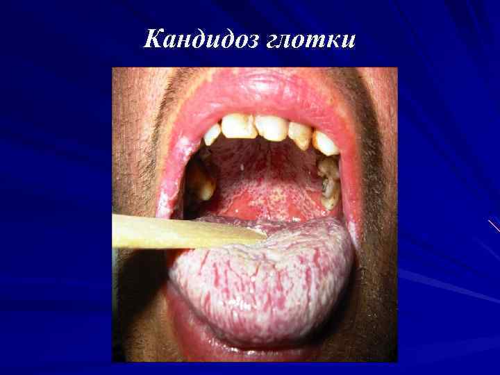 Кандидоз глотки 