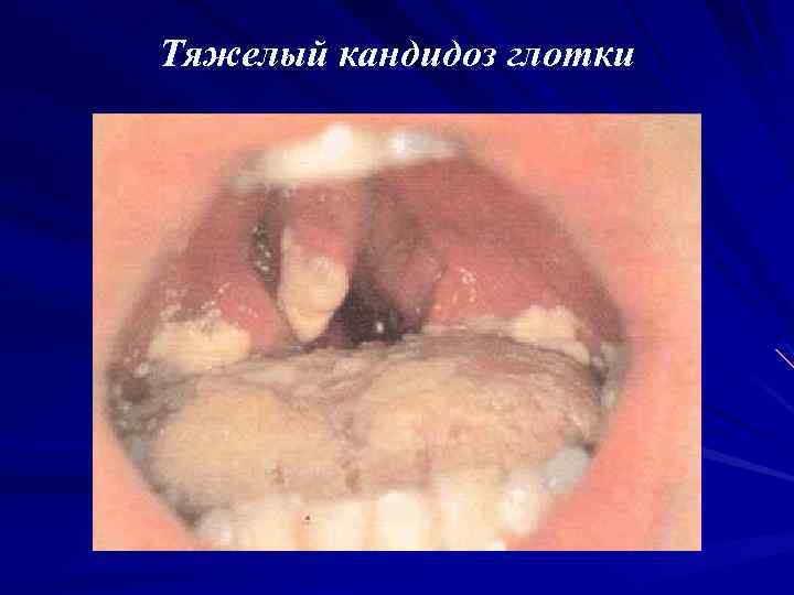 Тяжелый кандидоз глотки 