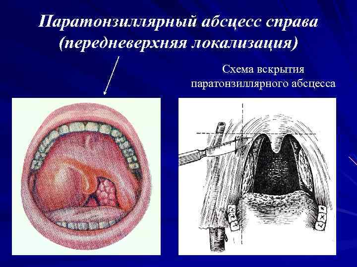 Паратонзиллярный абсцесс справа (передневерхняя локализация) Схема вскрытия паратонзиллярного абсцесса 