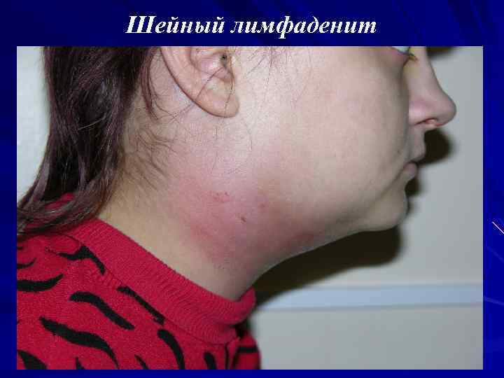 Шейный лимфаденит 