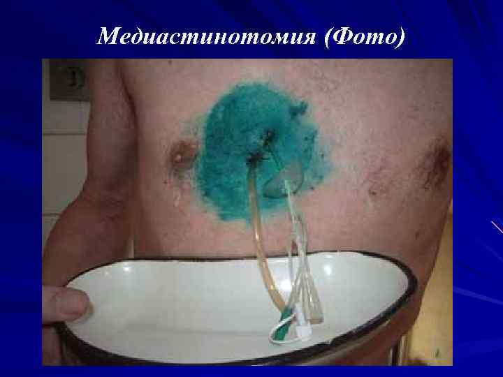Медиастинотомия (Фото) 