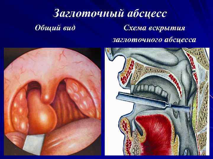 Заглоточный абсцесс Общий вид Схема вскрытия заглоточного абсцесса 