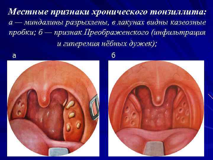 Местные признаки хронического тонзиллита: а — миндалины разрыхлены, в лакунах видны казеозные пробки; б