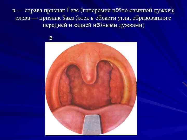 в — справа признак Гизе (гиперемия нёбно-язычной дужки); слева — признак Зака (отек в