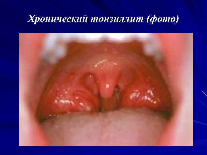 Хронический тонзиллит (фото) 