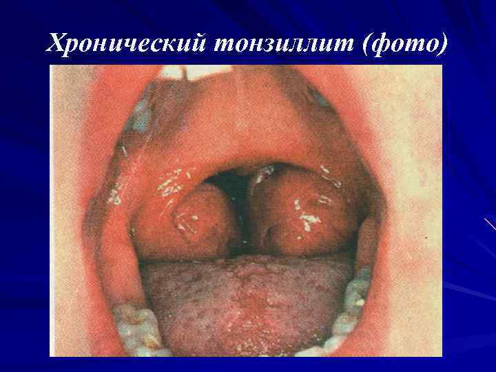 Хронический тонзиллит (фото) 