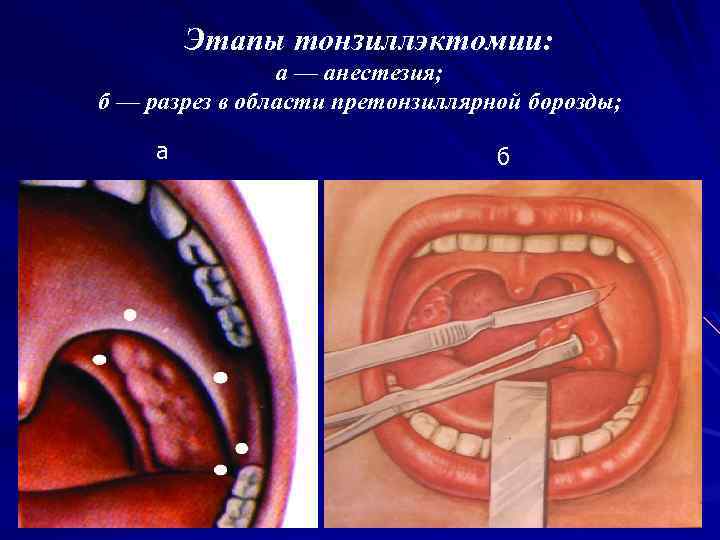 Этапы тонзиллэктомии: а — анестезия; б — разрез в области претонзиллярной борозды; а б