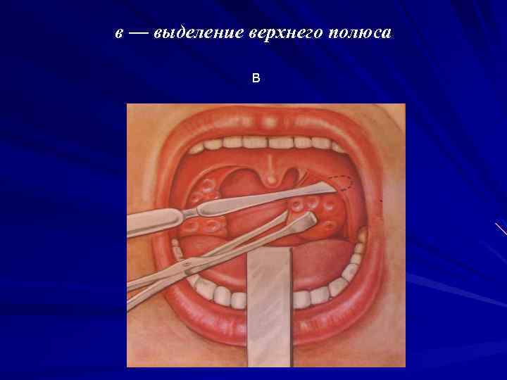 в — выделение верхнего полюса в 