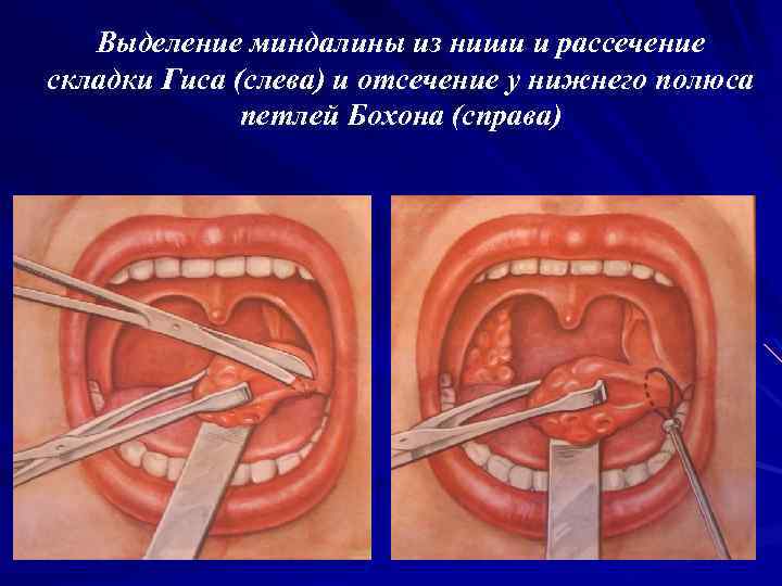Выделение миндалины из ниши и рассечение складки Гиса (слева) и отсечение у нижнего полюса