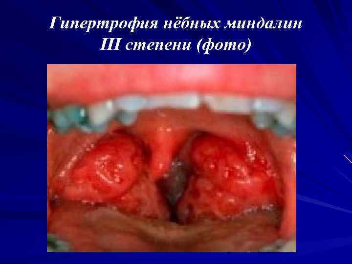 Гипертрофия нёбных миндалин III степени (фото) 