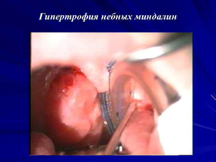 Гипертрофия небных миндалин 