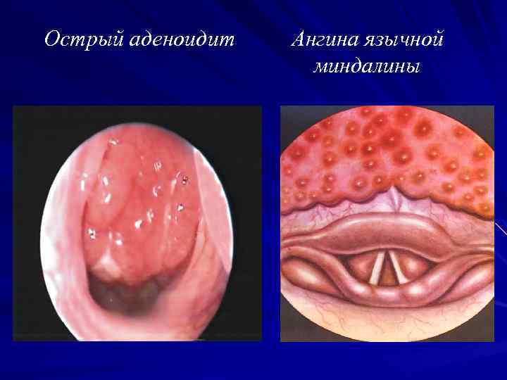 Острый аденоидит Ангина язычной миндалины 
