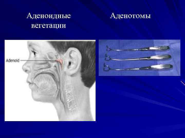 Аденоидные вегетации Аденотомы 