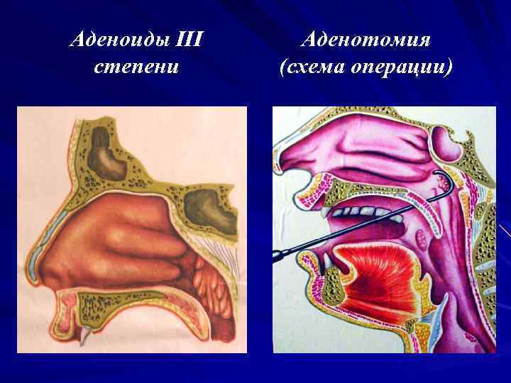 Аденоиды III степени Аденотомия (схема операции) 
