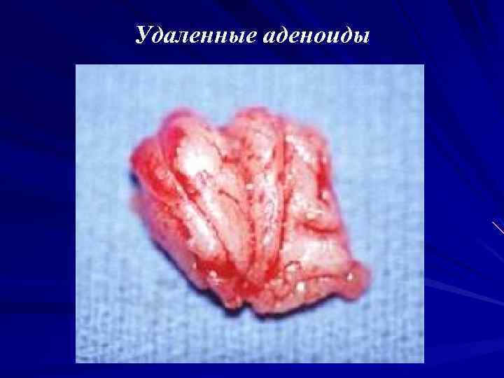Удаленные аденоиды 