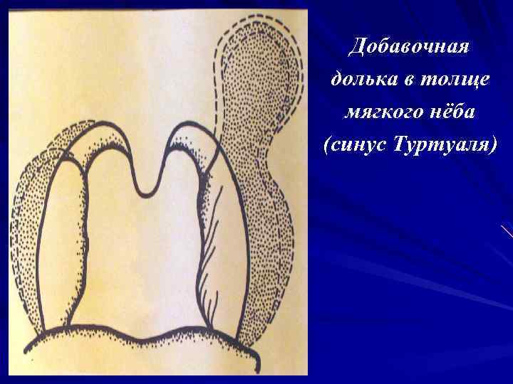 Добавочная долька в толще мягкого нёба (синус Туртуаля) 