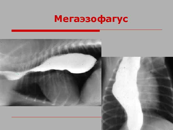 Мегаэзофагус 