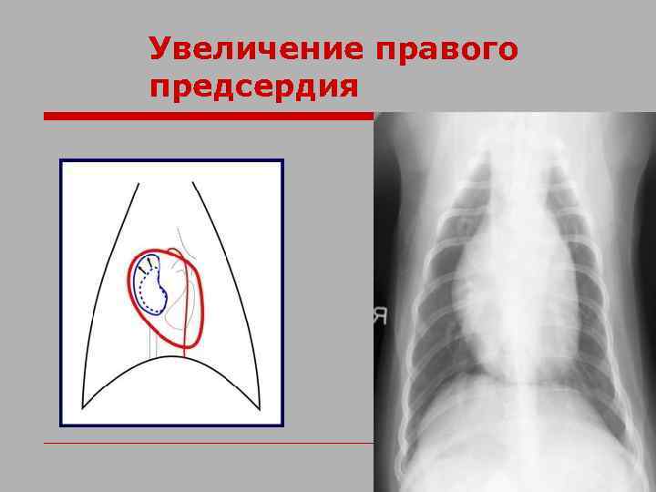 Увеличение правого предсердия 