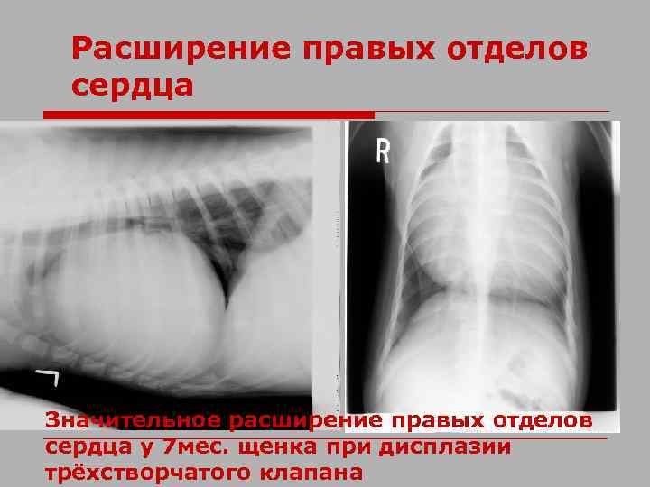 Увеличено правое. Расширение правых отделов сердца. Расширение правых отделов сердца причины. Дилатация правых отделов сердца. Изолированная дилатация правых отделов сердца.