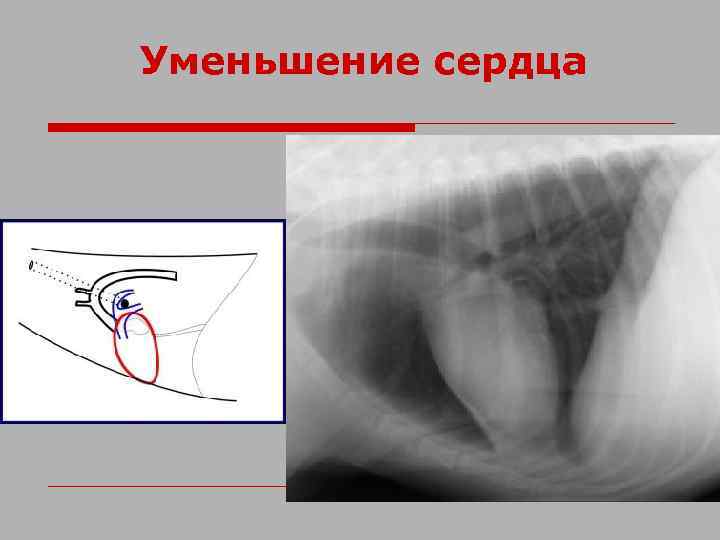 Уменьшение сердца 