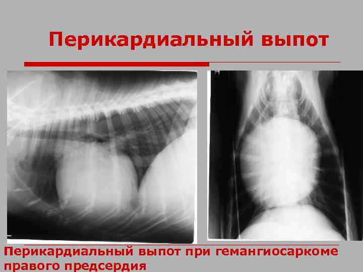 Перикардиальный выпот при гемангиосаркоме правого предсердия 