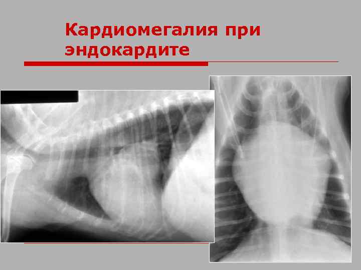 Кардиомегалия при эндокардите 