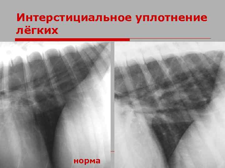 Интерстициальное уплотнение лёгких норма 