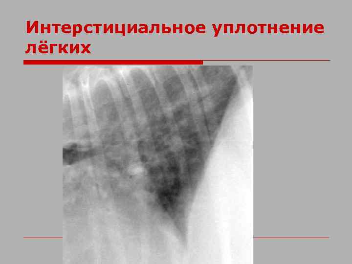 Интерстициальное уплотнение лёгких 