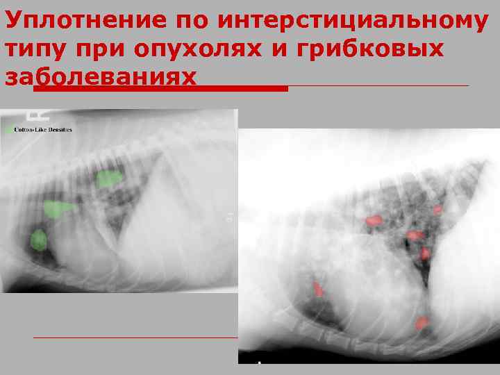 Уплотнение по интерстициальному типу при опухолях и грибковых заболеваниях 