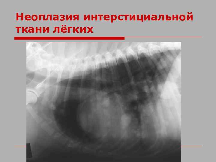 Неоплазия интерстициальной ткани лёгких 