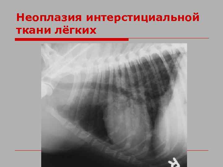 Неоплазия интерстициальной ткани лёгких 