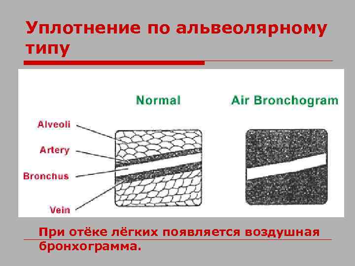 Уплотнение по альвеолярному типу При отёке лёгких появляется воздушная бронхограмма. 