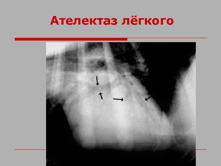 Ателектаз лёгкого 