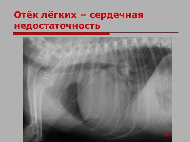 Отёк лёгких – сердечная недостаточность 1. 