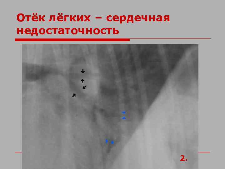 Отёк лёгких – сердечная недостаточность 2. 