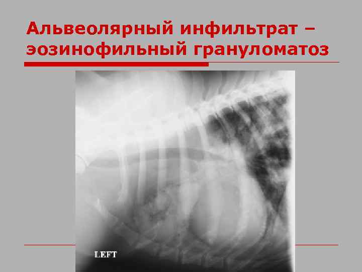 Альвеолярный инфильтрат – эозинофильный грануломатоз 