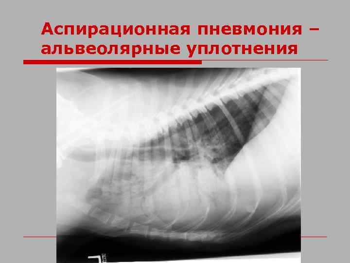 Аспирационная пневмония – альвеолярные уплотнения 