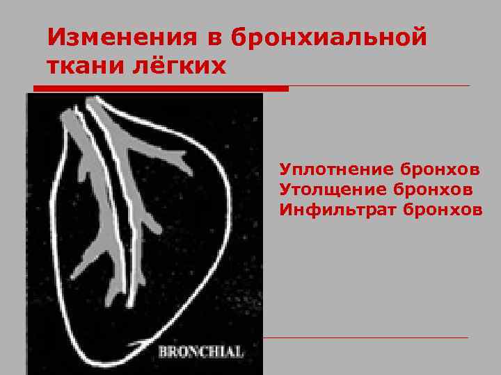 Изменения в бронхиальной ткани лёгких Уплотнение бронхов Утолщение бронхов Инфильтрат бронхов 