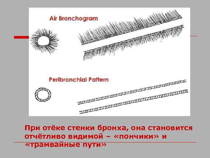 При отёке стенки бронха, она становится отчётливо видимой – «пончики» и «трамвайные пути» 