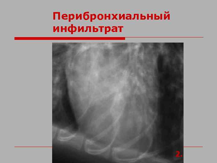 Перибронхиальный инфильтрат 2. 