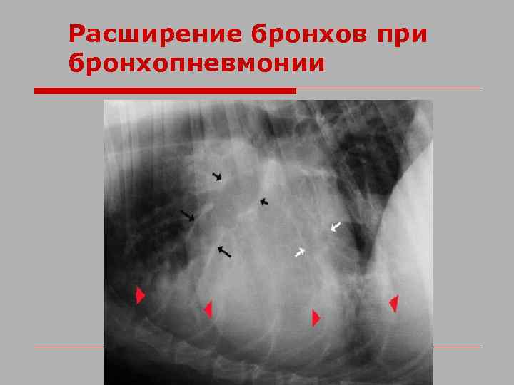 Расширение бронхов при бронхопневмонии 