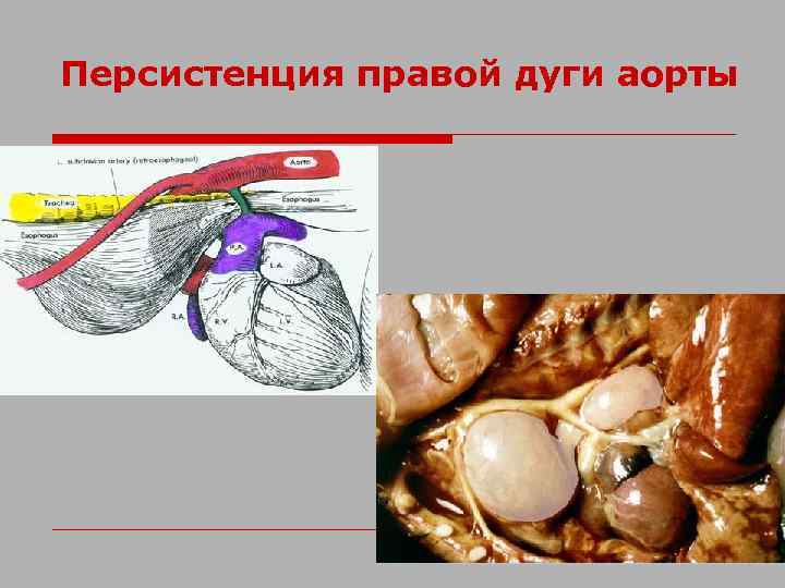 Персистенция правой дуги аорты 