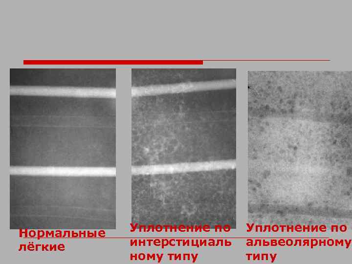 Нормальные лёгкие Уплотнение по интерстициаль ному типу Уплотнение по альвеолярному типу 