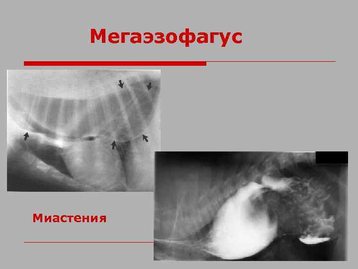 Мегаэзофагус Миастения 