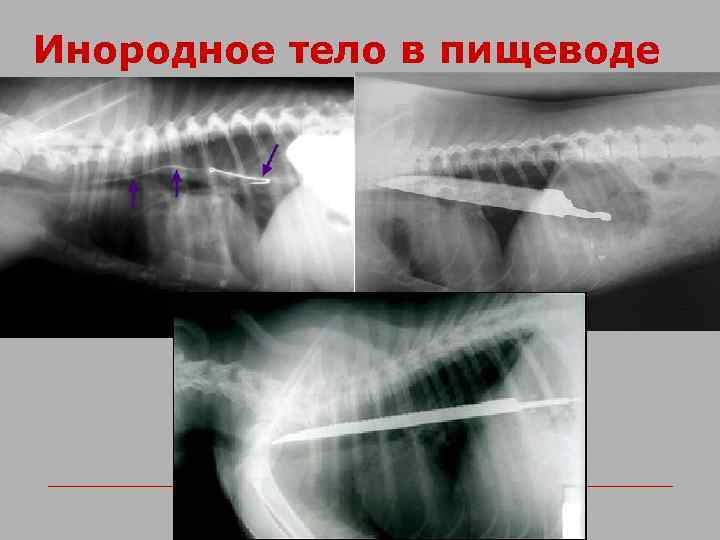 Инородное тело в пищеводе 